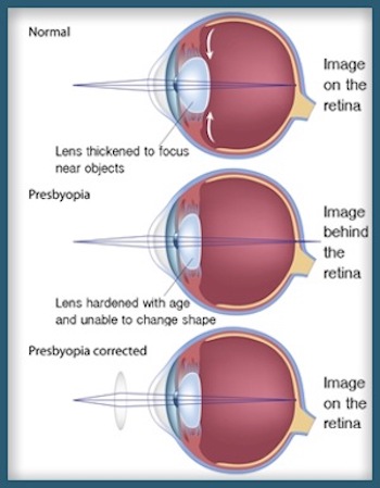 hyperopia myopia and presbyopia)