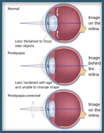 hyperopia myopia and presbyopia