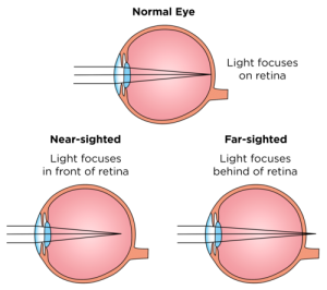 Eyes For Life Patient Education Correcting Common Refractive Errors